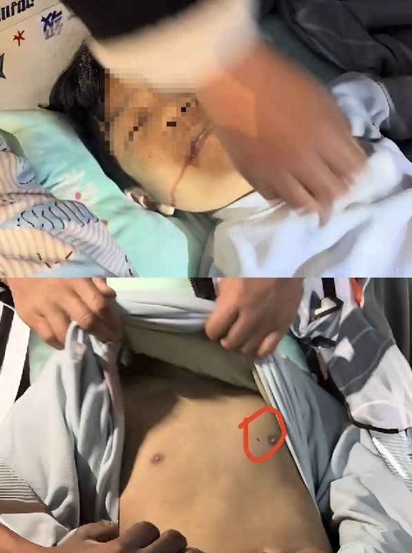 家属发现孩子非正常死亡，嘴角流血，胸口处有一个洞，疑似针孔查看原文