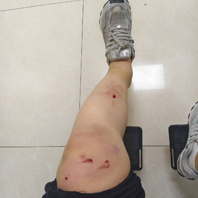 5月22日，一位兼职跑外卖的网友在网上分享，跑了九个月外卖一共赚了一万多块，一场事故一次手术刚好花掉这一万块