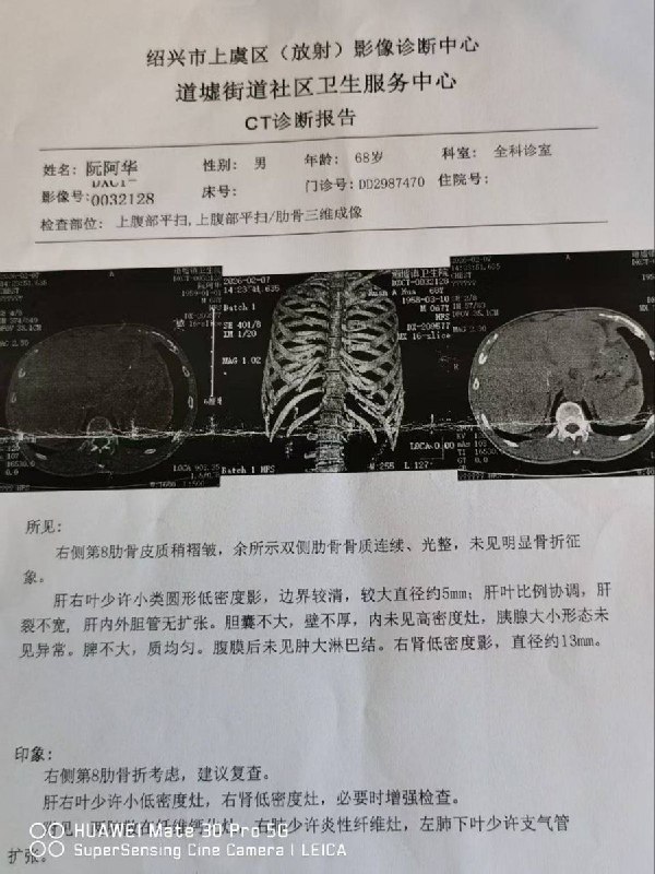 网友投稿：2月10日，河南村镇银行储户阮阿华被确诊为肋骨骨折