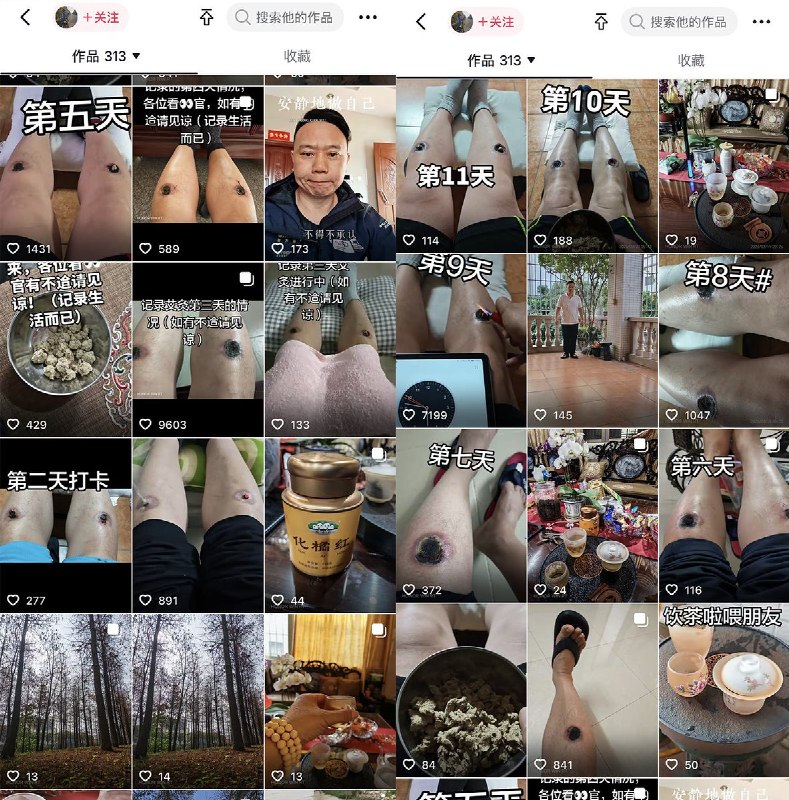 最近，广东中山一名男子自学中医，每天用艾灸灼烧自己的双腿，并用视频记录下每天艾灸的过程以及身体变化